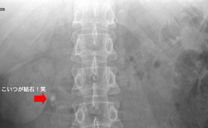 入院と結石と私〜2016　前半