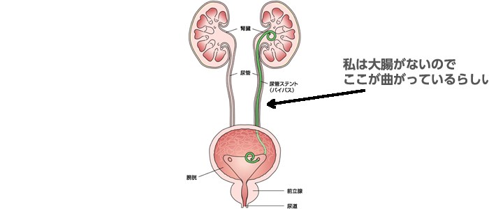 入院と結石と私〜2016　中編